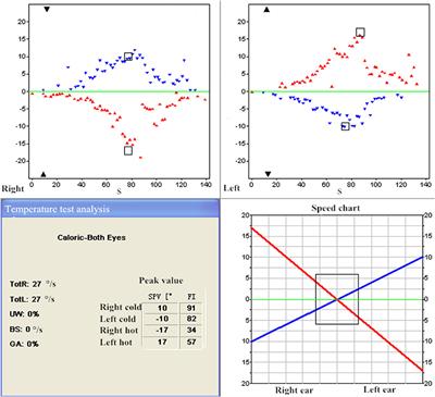 Pseudo-Benign Paroxysmal Positional Vertigo: A Retrospective Study and Case Report